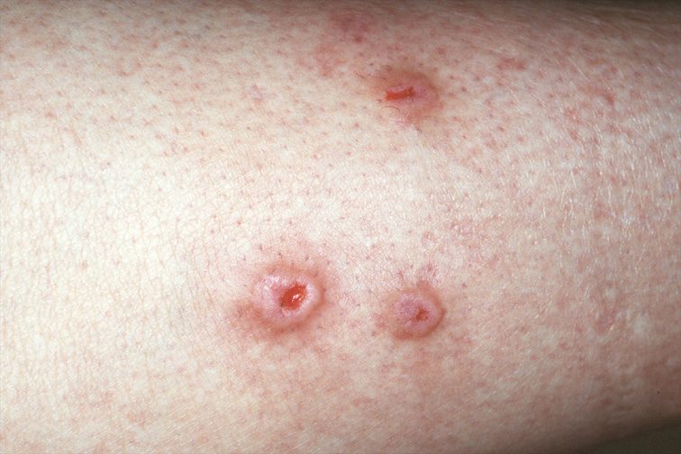 neirodermatit-1-5422522