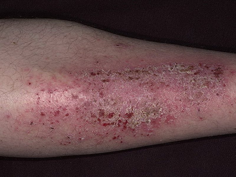 neirodermatit-2-6461584