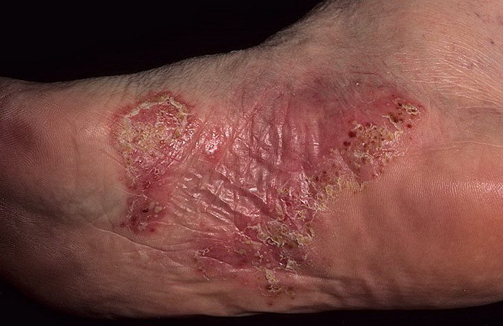 neirodermatit-5992954