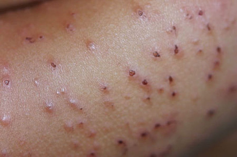 zydashii-dermatit-2-8898895