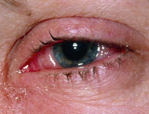 allergicheskij-konyunktivit-4-e1454147810151-4712166
