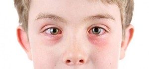 allergicheskij-konyunktivit-e1454147545151-4140294