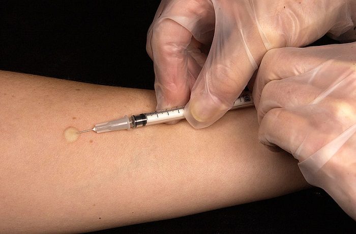 pollinoz-sezonnaya-allergicheskaya-reaktsiya-11-6140302