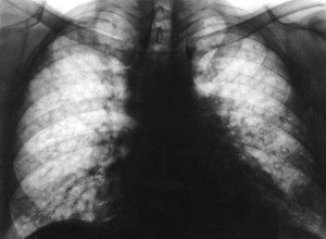 ekzogennyj-allergicheskij-alveolit1-e1454598275765-8809551