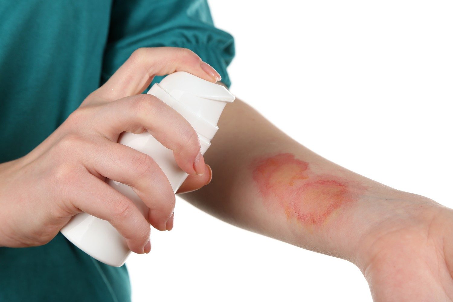 atopicheskii-dermatit-11-1321230