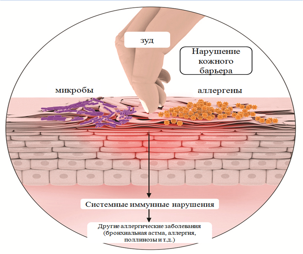 atopicheskii-dermatit-2-3956547