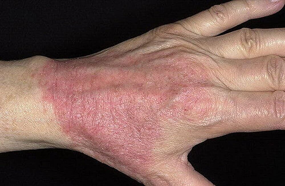 atopicheskii-dermatit-2421073