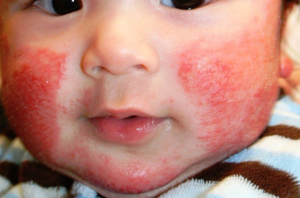 atopicheskii-dermatit-3-4012618