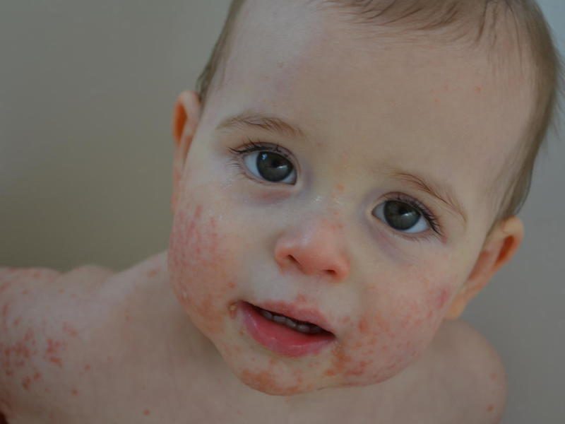 atopicheskii-dermatit-4-2894857