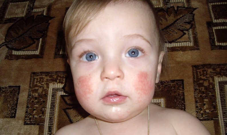 atopicheskii-dermatit-5-2278446
