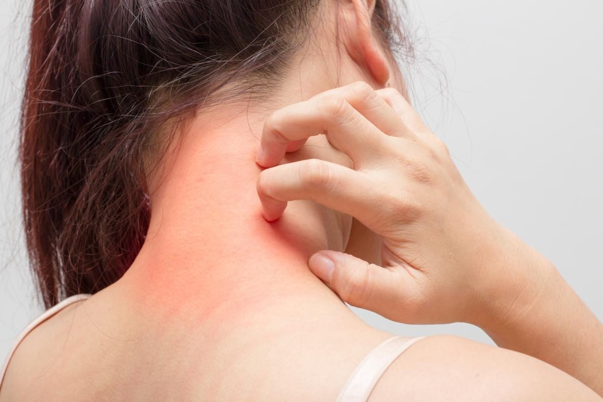 atopicheskii-dermatit-6-3879994