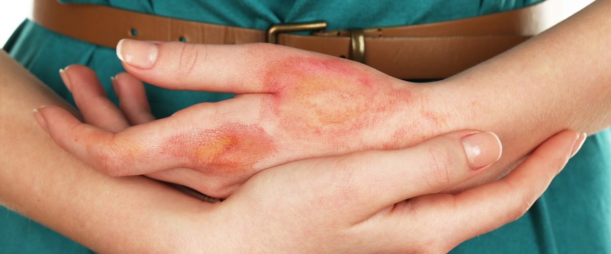 atopicheskii-dermatit-7-2201951