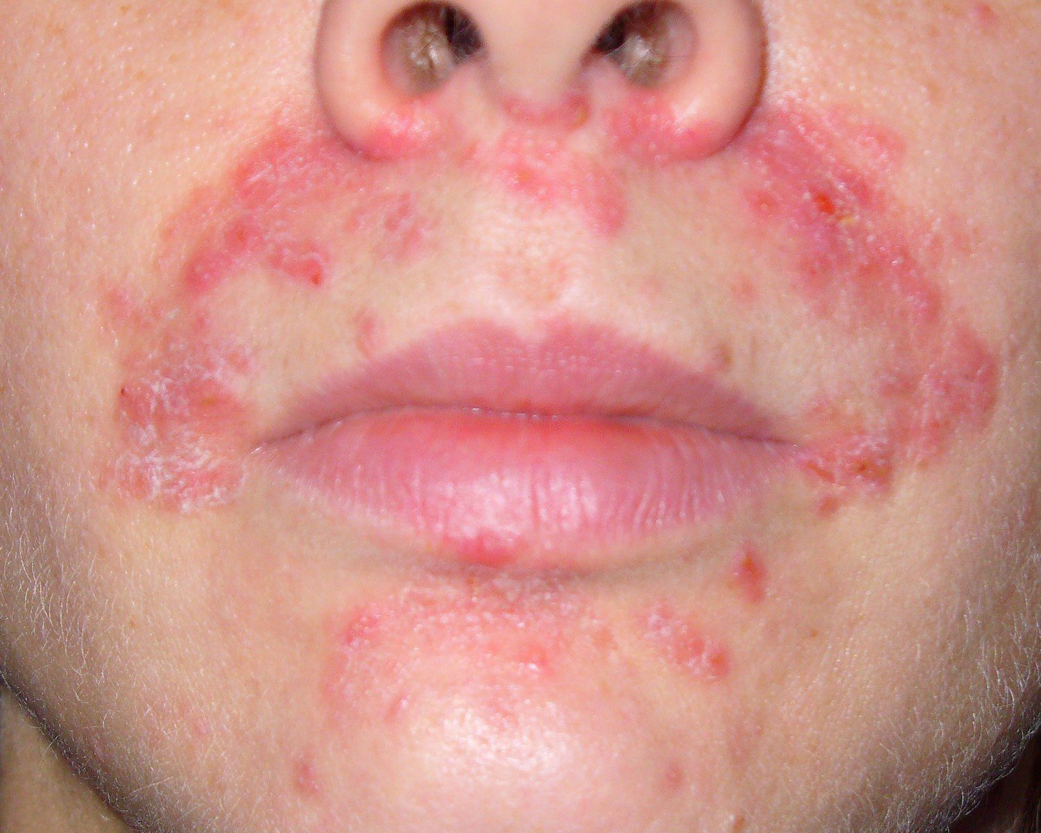 atopicheskii-dermatit-8-5121223