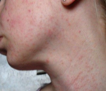 allergiya-na-chay-1-e1452089280278-2236830