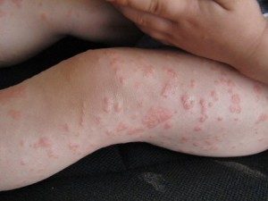 allergiya-na-folievuyu-kislotu-e1458292440624-8805439