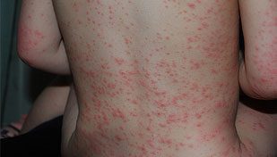 allergiya-na-klubniku-8812535
