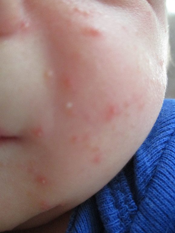 allergiya-na-luk-1-8818004