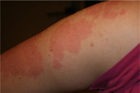 allergiya-na-luk-5064868