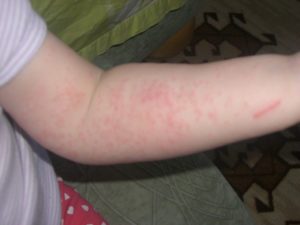 allergiya-na-ogurtsy-3-300x225-3311089