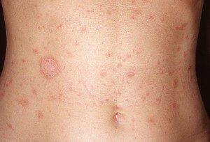 allergiya-na-rybu-1-e1456634297997-4912933