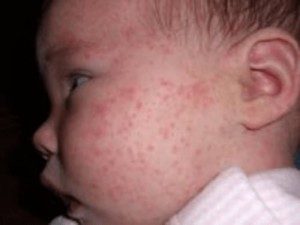 allergiya-na-rybu-5-e1456634319142-1562159