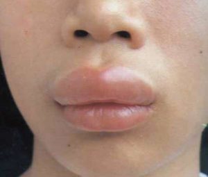 allergiya_na_nikel2-300x255-5546365