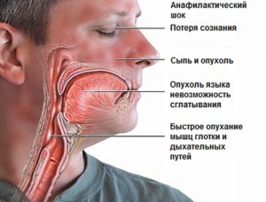 anafilakticheskij_shok-300x228-9768997