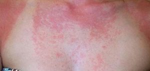 sredstva-ot-allergii-ot-solntsa-2-300x142-8517799