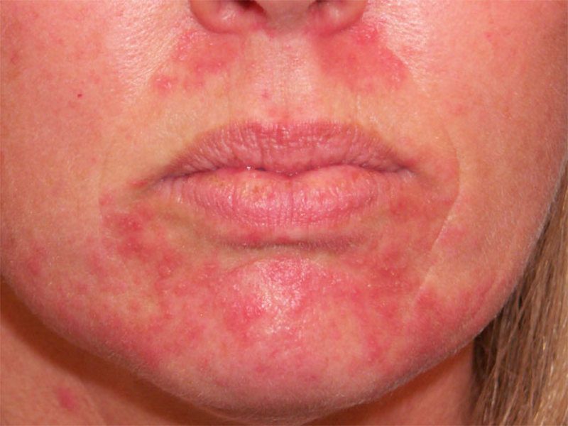 steroidnii-dermatit-1-3739713