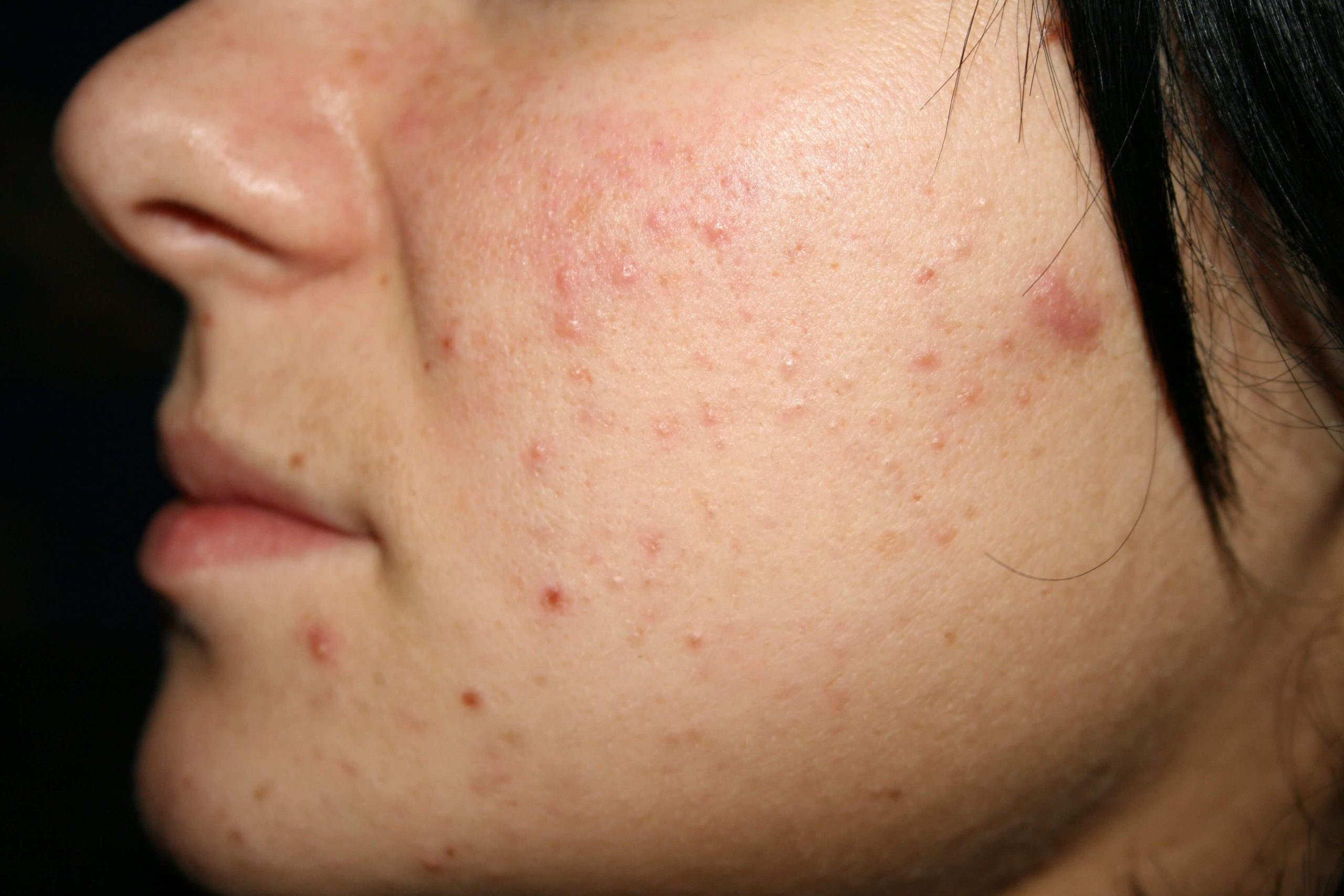 steroidnii-dermatit-1973626