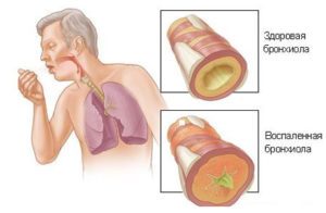allergy-na-bumagu3-300x196-8221102