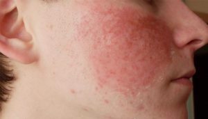 allergy-na-insulin2-300x171-6500360