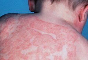 allergy-na-insulin4-300x204-5478412