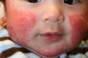 allergy-na-kislomolo4nye-produkty1-300x198-3811065