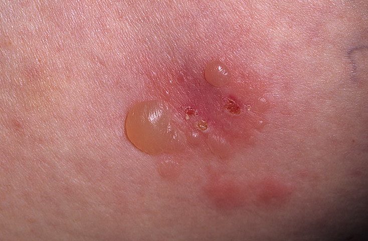 dermatit-dyuringa-2-9660199