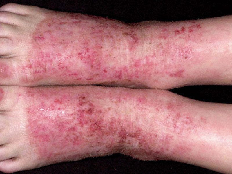 dermatit-na-noge-1958835