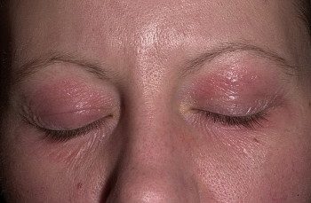 dermatit-vek-2-e1452428305602-8941144