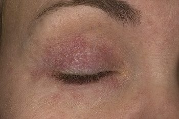 dermatit-vek-3-e1452428312803-1471460
