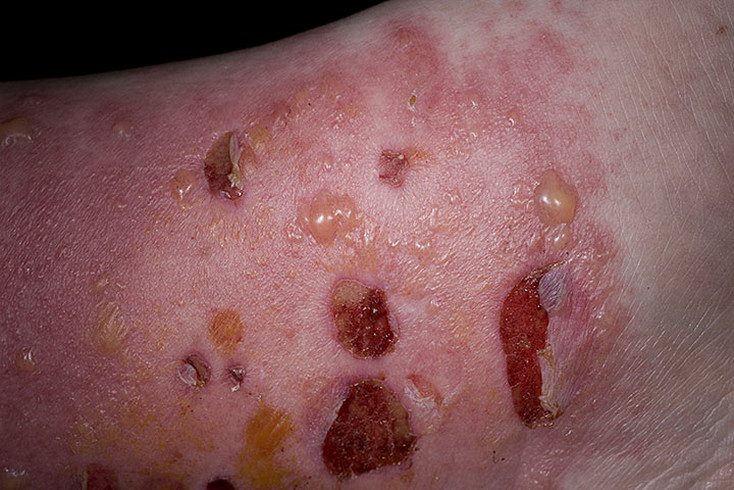 pyzirchatii-dermatit-3-9898194