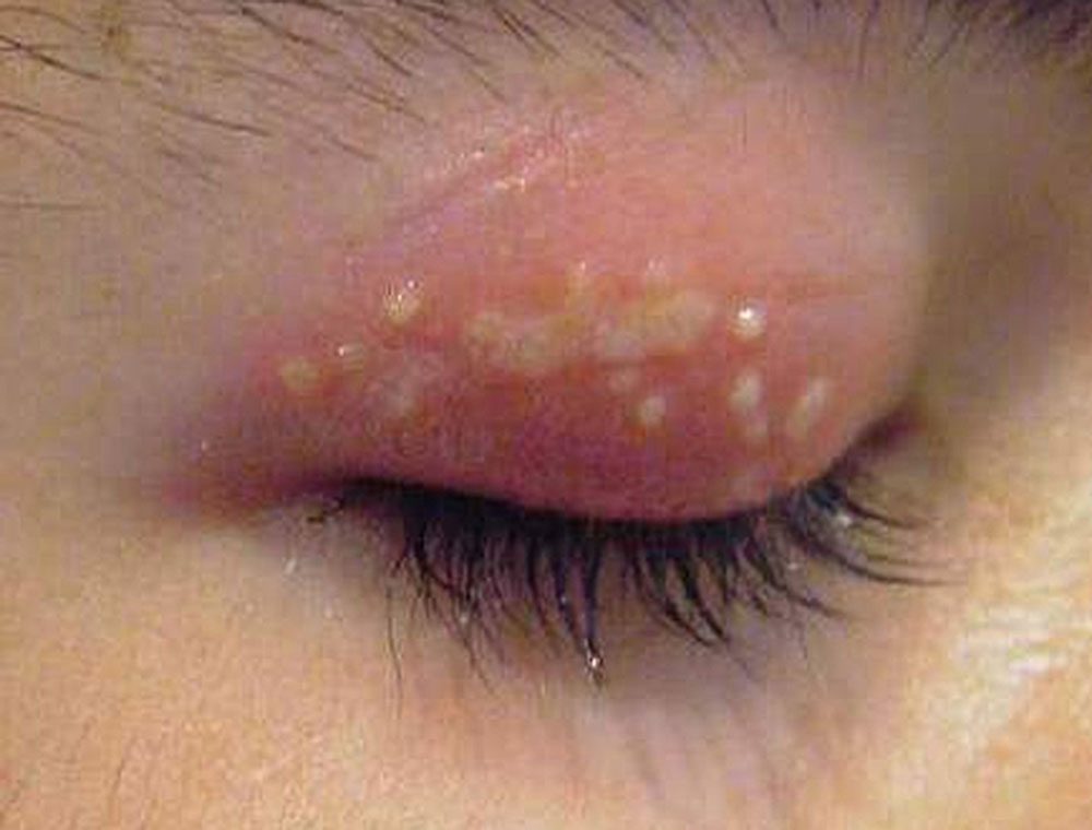 pyzirchatii-dermatit-5623637