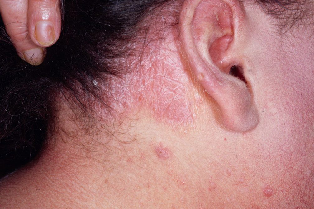 ychnoi-dermatit-9637913